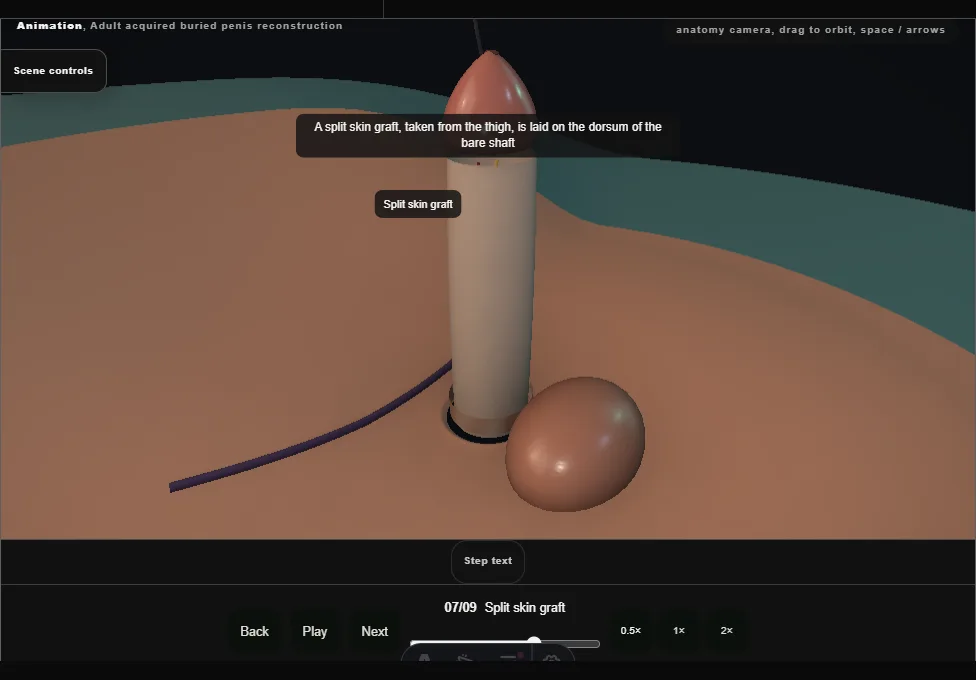 Adult acquired buried penis reconstruction. Step 7: Split skin graft. Captured frame from the interactive animation.