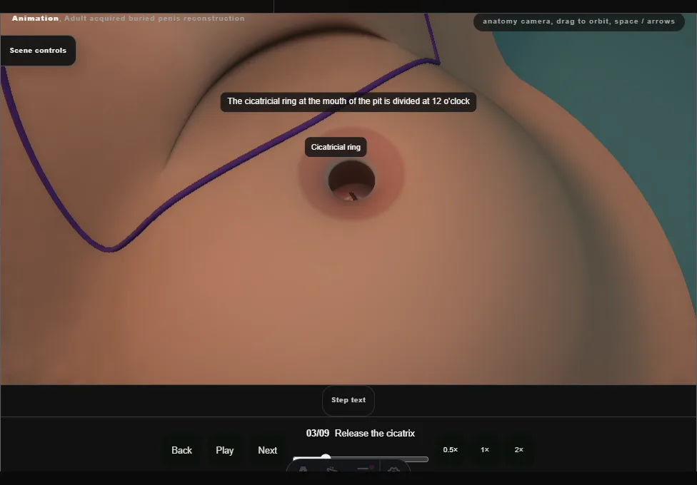 Adult acquired buried penis reconstruction. Step 3: Release the cicatrix. Captured frame from the interactive animation.
