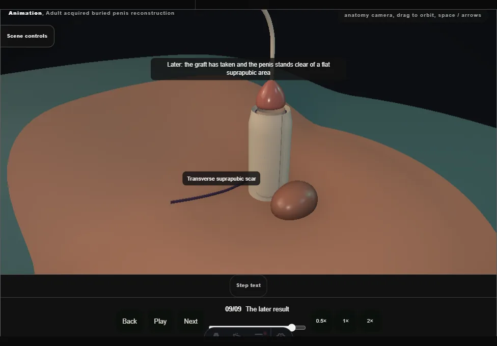 Adult acquired buried penis reconstruction. Step 9: The later result. Captured frame from the interactive animation.