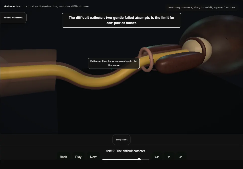 Urethral catheterisation, and the difficult one. Step 9: The difficult catheter. Captured frame from the interactive animation.