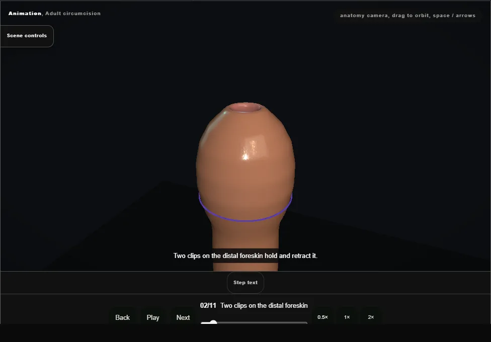 Adult circumcision. Step 2: Two clips on the distal foreskin. Captured frame from the interactive animation.