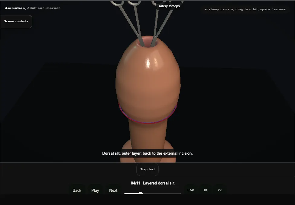 Adult circumcision. Step 4: Layered dorsal slit. Captured frame from the interactive animation.