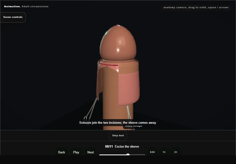Adult circumcision. Step 8: Excise the sleeve. Captured frame from the interactive animation.