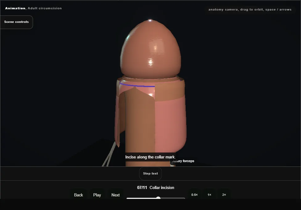 Adult circumcision. Step 7: Collar incision. Captured frame from the interactive animation.