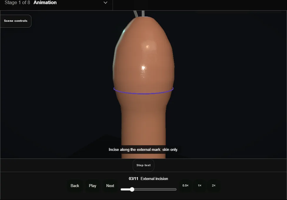 Adult circumcision. Step 3: External incision. Captured frame from the interactive animation.