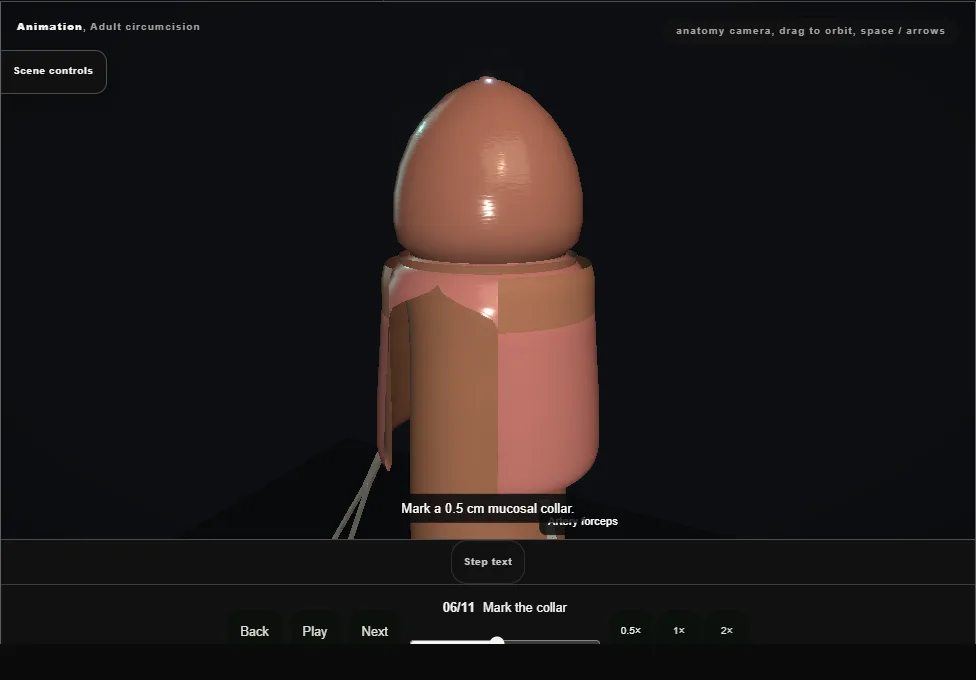 Adult circumcision. Step 6: Mark the collar. Captured frame from the interactive animation.