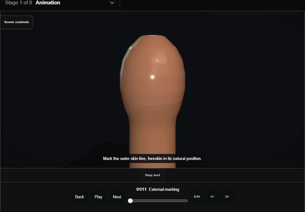 Adult circumcision. Step 1: External marking. Captured frame from the interactive animation.