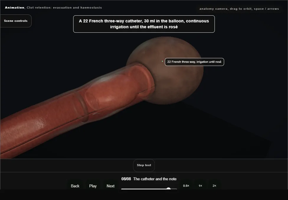 Clot retention: evacuation and haemostasis. Step 8: The catheter and the note. Captured frame from the interactive animation.