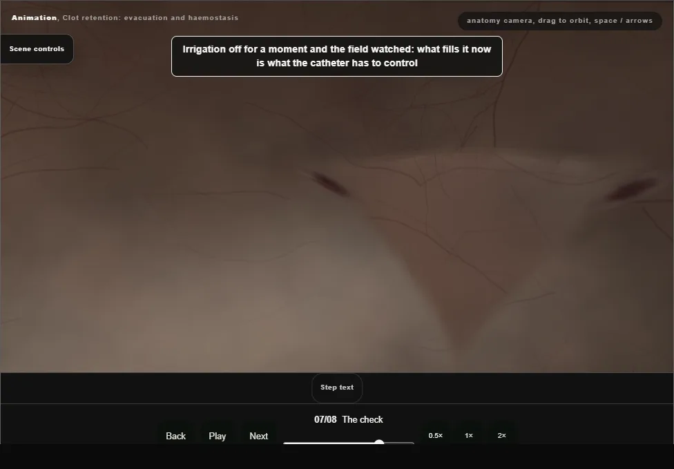 Clot retention: evacuation and haemostasis. Step 7: The check. Captured frame from the interactive animation.