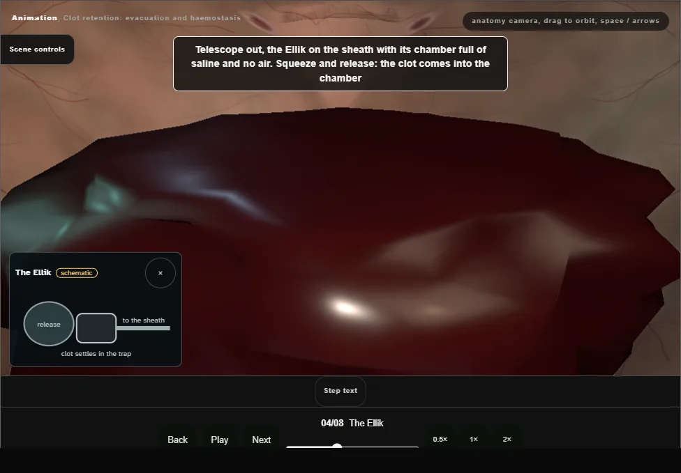 Clot retention: evacuation and haemostasis. Step 4: The Ellik. Captured frame from the interactive animation.