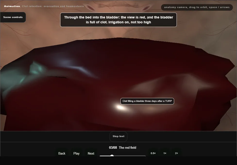 Clot retention: evacuation and haemostasis. Step 3: The red field. Captured frame from the interactive animation.