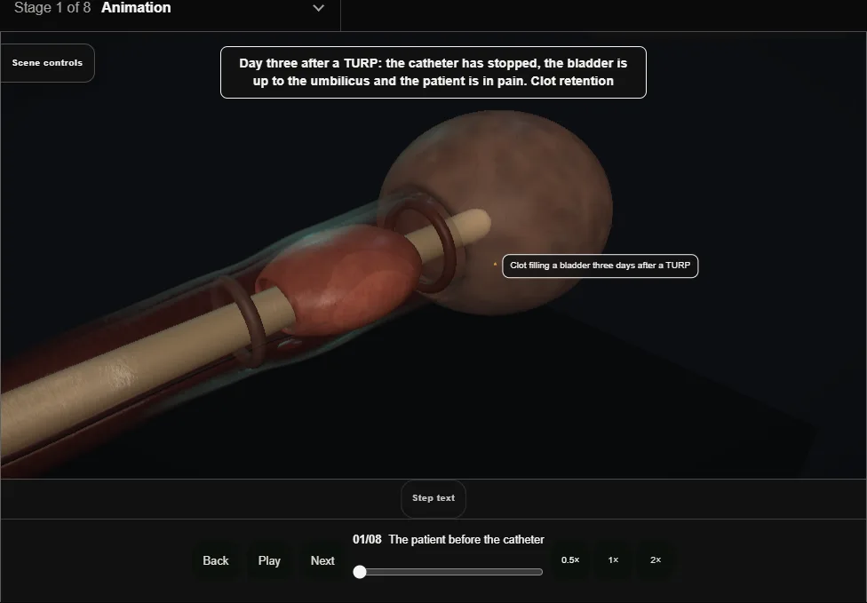 Clot retention: evacuation and haemostasis. Step 1: The patient before the catheter. Captured frame from the interactive animation.