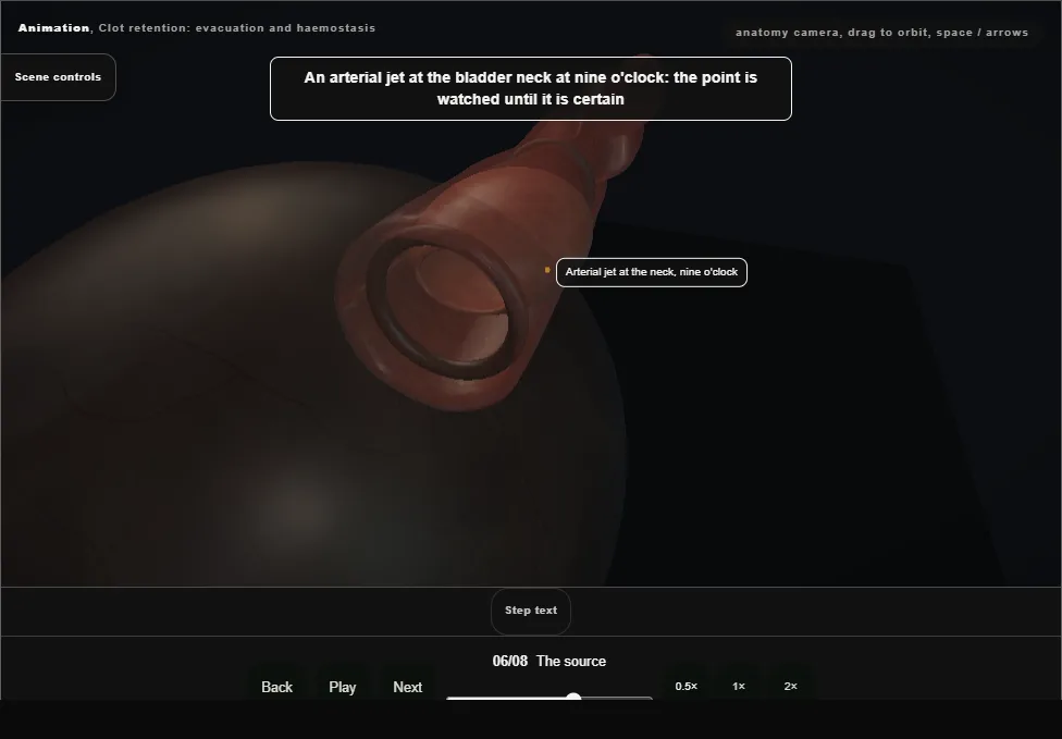 Clot retention: evacuation and haemostasis. Step 6: The source. Captured frame from the interactive animation.