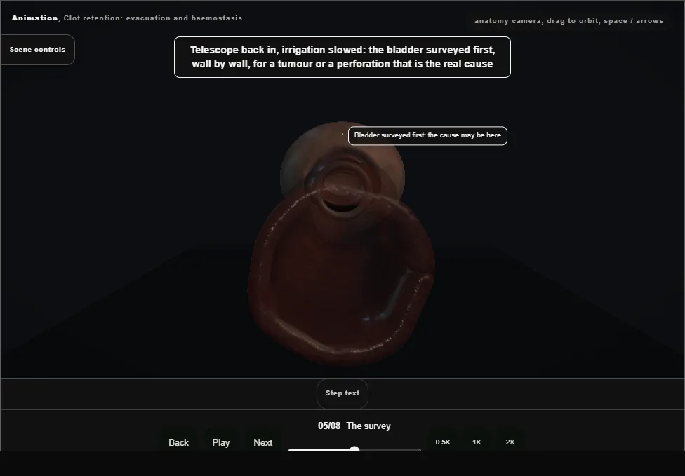Clot retention: evacuation and haemostasis. Step 5: The survey. Captured frame from the interactive animation.