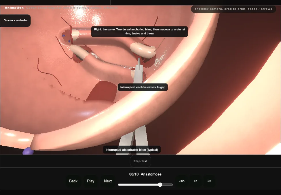 Cohen cross-trigonal ureteric reimplantation, bilateral. Step 8: Anastomose. Captured frame from the interactive animation.