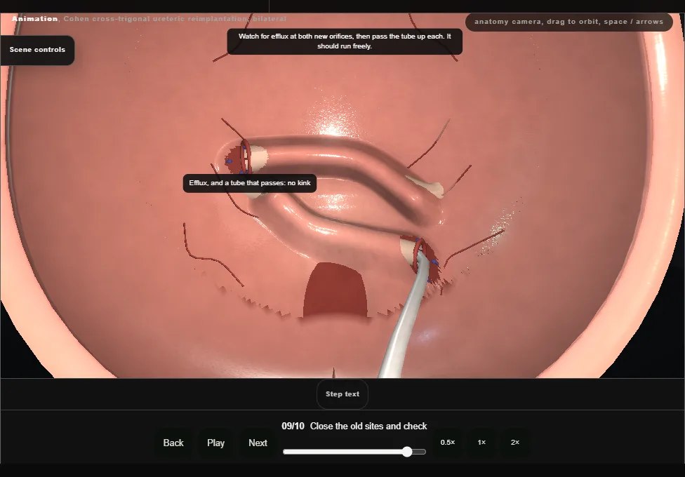 Cohen cross-trigonal ureteric reimplantation, bilateral. Step 9: Close the old sites and check. Captured frame from the interactive animation.