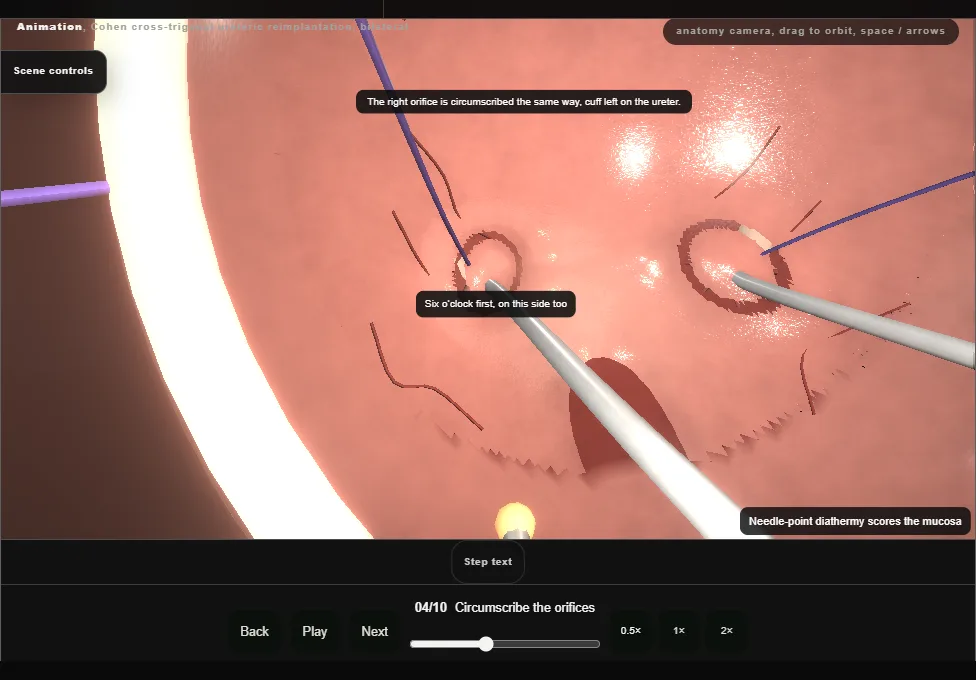 Cohen cross-trigonal ureteric reimplantation, bilateral. Step 4: Circumscribe the orifices. Captured frame from the interactive animation.