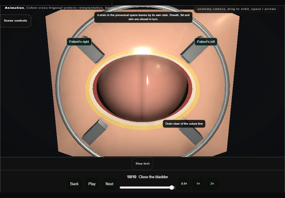 Cohen cross-trigonal ureteric reimplantation, bilateral. Step 10: Close the bladder. Captured frame from the interactive animation.