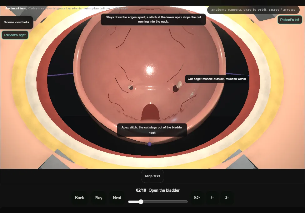 Cohen cross-trigonal ureteric reimplantation, bilateral. Step 2: Open the bladder. Captured frame from the interactive animation.