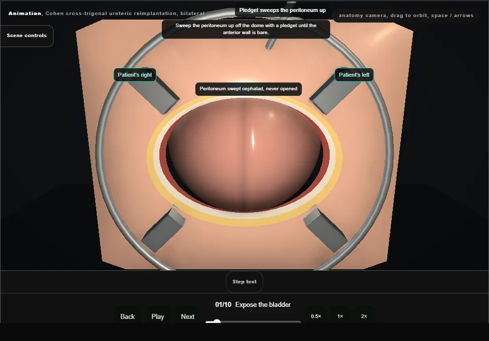 Cohen cross-trigonal ureteric reimplantation, bilateral. Step 1: Expose the bladder. Captured frame from the interactive animation.