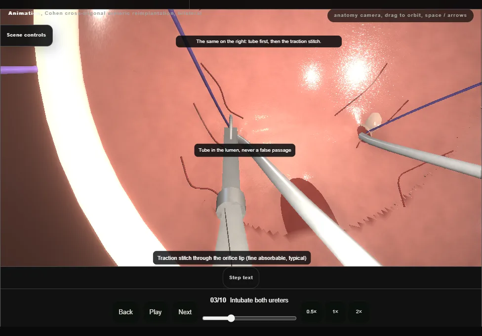 Cohen cross-trigonal ureteric reimplantation, bilateral. Step 3: Intubate both ureters. Captured frame from the interactive animation.