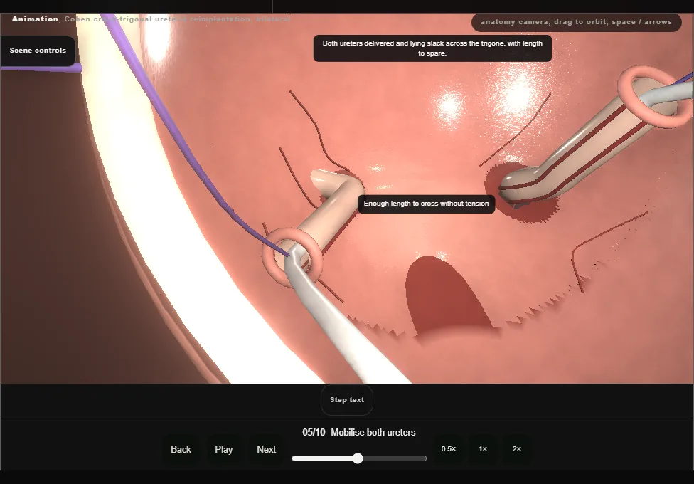 Cohen cross-trigonal ureteric reimplantation, bilateral. Step 5: Mobilise both ureters. Captured frame from the interactive animation.