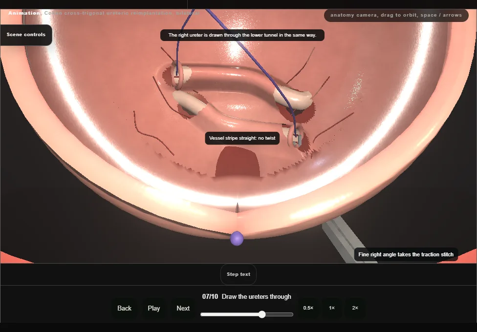 Cohen cross-trigonal ureteric reimplantation, bilateral. Step 7: Draw the ureters through. Captured frame from the interactive animation.