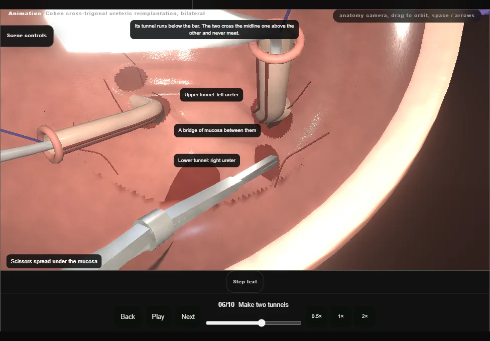 Cohen cross-trigonal ureteric reimplantation, bilateral. Step 6: Make two tunnels. Captured frame from the interactive animation.