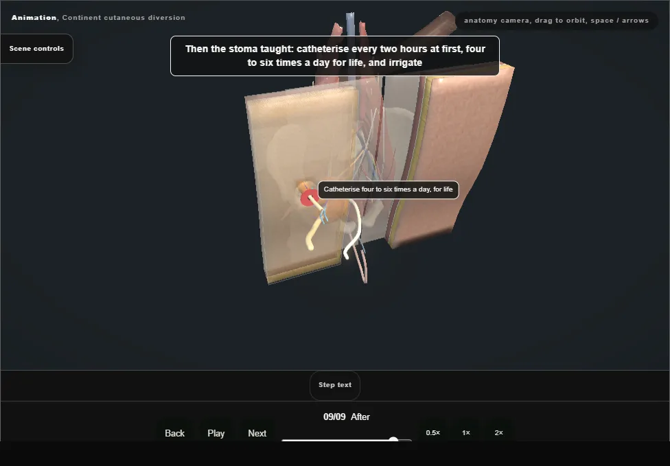 Continent cutaneous diversion. Step 9: After. Captured frame from the interactive animation.