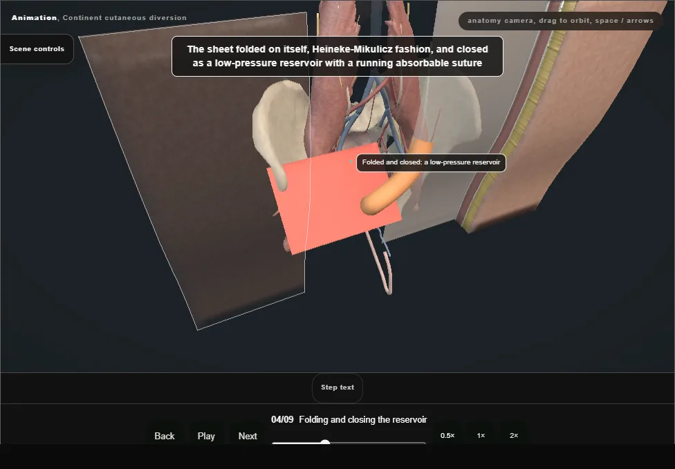 Continent cutaneous diversion. Step 4: Folding and closing the reservoir. Captured frame from the interactive animation.