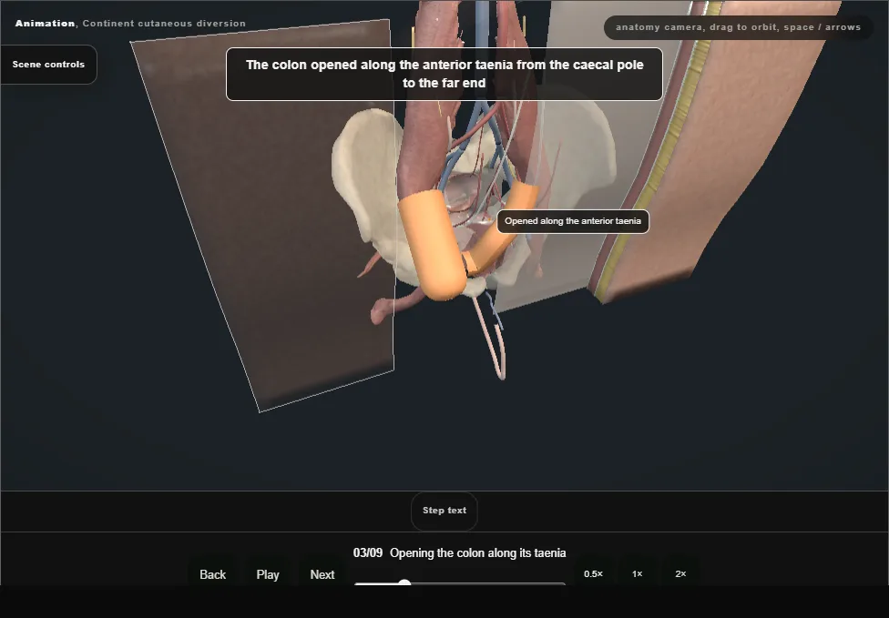 Continent cutaneous diversion. Step 3: Opening the colon along its taenia. Captured frame from the interactive animation.