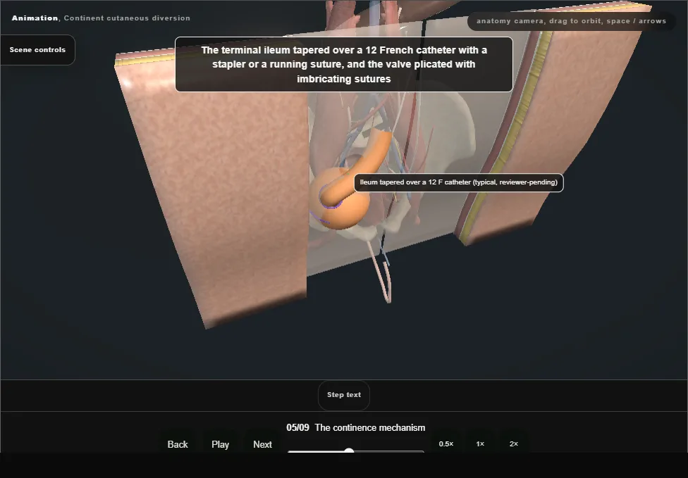 Continent cutaneous diversion. Step 5: The continence mechanism. Captured frame from the interactive animation.