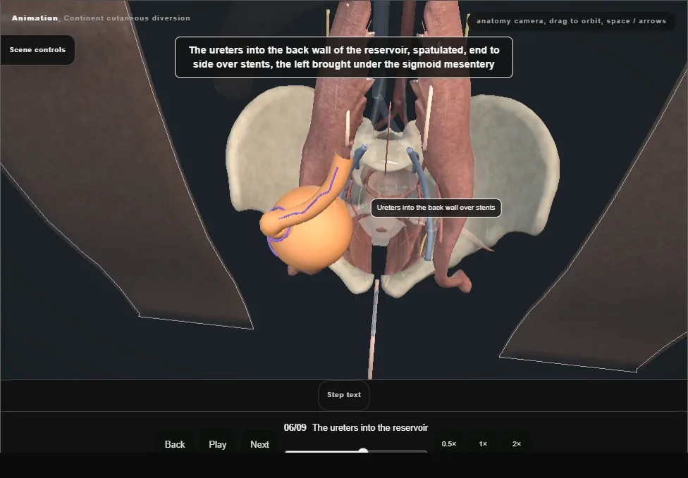 Continent cutaneous diversion. Step 6: The ureters into the reservoir. Captured frame from the interactive animation.