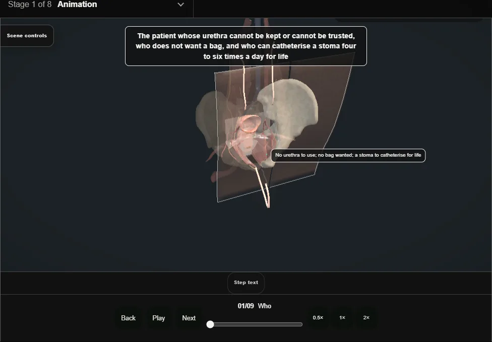 Continent cutaneous diversion. Step 1: Who. Captured frame from the interactive animation.