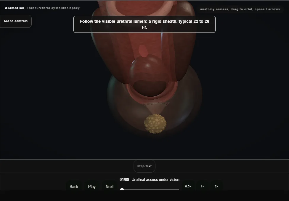 Transurethral cystolitholapaxy. Step 1: Urethral access under vision. Captured frame from the interactive animation.