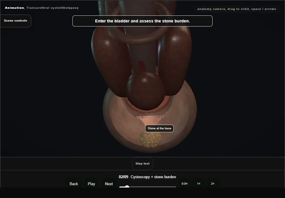 Transurethral cystolitholapaxy. Step 2: Cystoscopy + stone burden. Captured frame from the interactive animation.