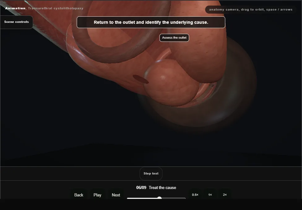 Transurethral cystolitholapaxy. Step 6: Treat the cause. Captured frame from the interactive animation.