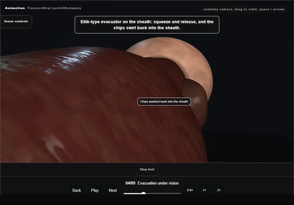 Transurethral cystolitholapaxy. Step 4: Evacuation under vision. Captured frame from the interactive animation.