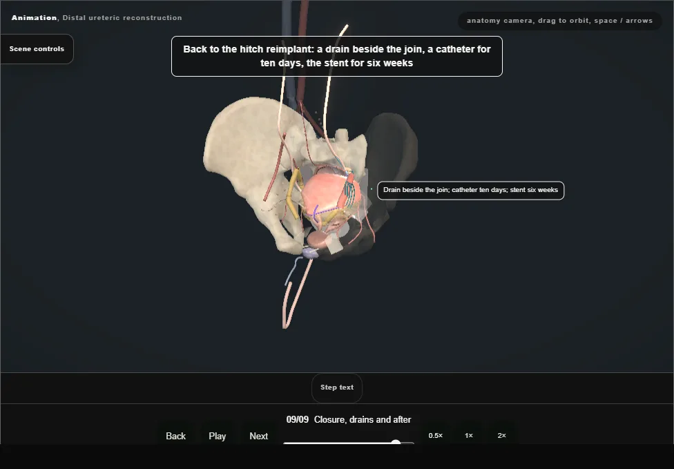 Distal ureteric reconstruction. Step 9: Closure, drains and after. Captured frame from the interactive animation.