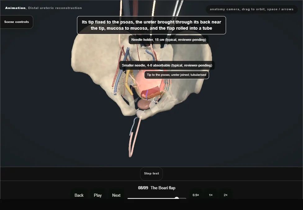 Distal ureteric reconstruction. Step 8: The Boari flap. Captured frame from the interactive animation.