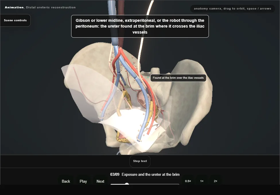 Distal ureteric reconstruction. Step 3: Exposure and the ureter at the brim. Captured frame from the interactive animation.
