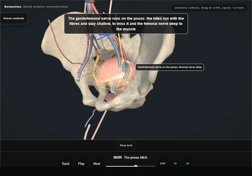 Distal ureteric reconstruction. Step 6: The psoas hitch. Captured frame from the interactive animation.