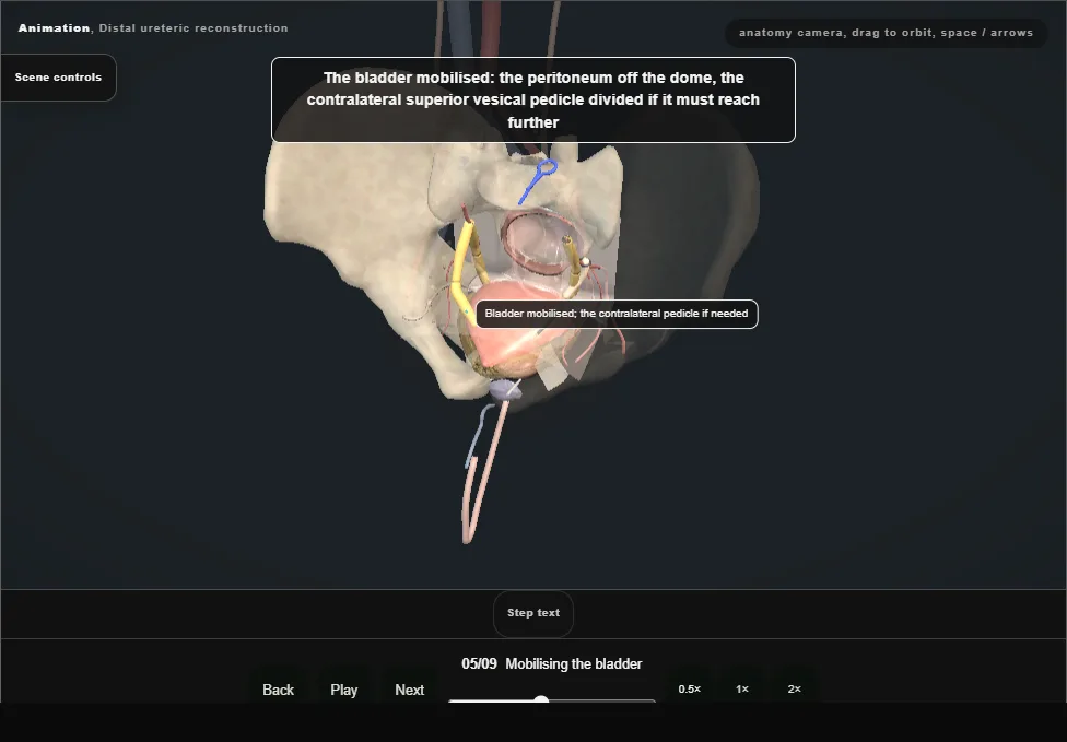 Distal ureteric reconstruction. Step 5: Mobilising the bladder. Captured frame from the interactive animation.
