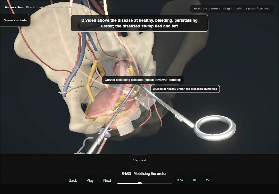 Distal ureteric reconstruction. Step 4: Mobilising the ureter. Captured frame from the interactive animation.