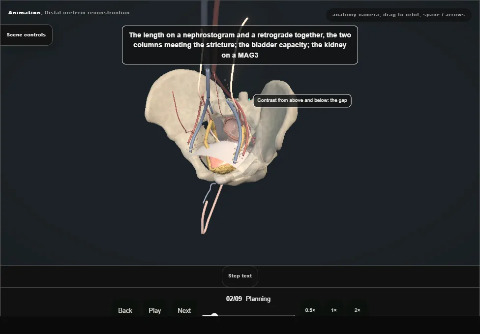 Distal ureteric reconstruction. Step 2: Planning. Captured frame from the interactive animation.