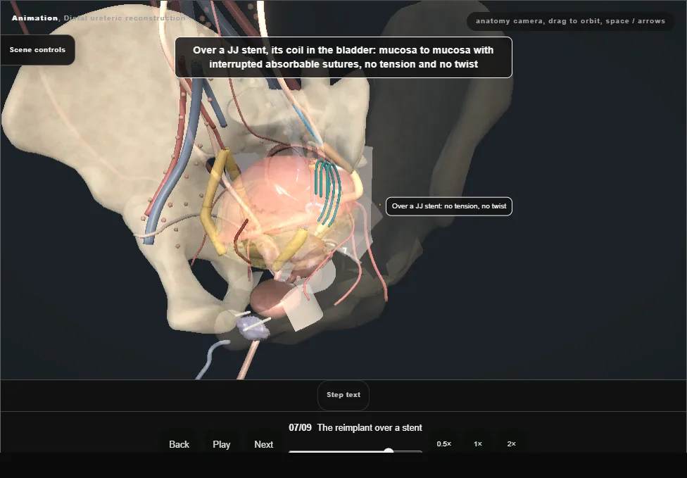 Distal ureteric reconstruction. Step 7: The reimplant over a stent. Captured frame from the interactive animation.
