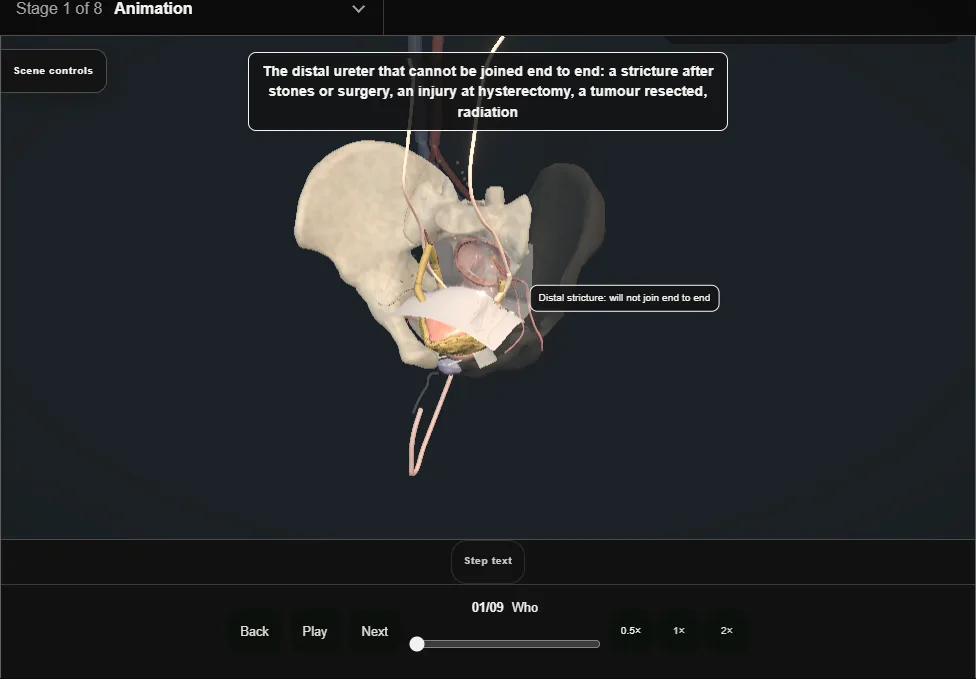 Distal ureteric reconstruction. Step 1: Who. Captured frame from the interactive animation.