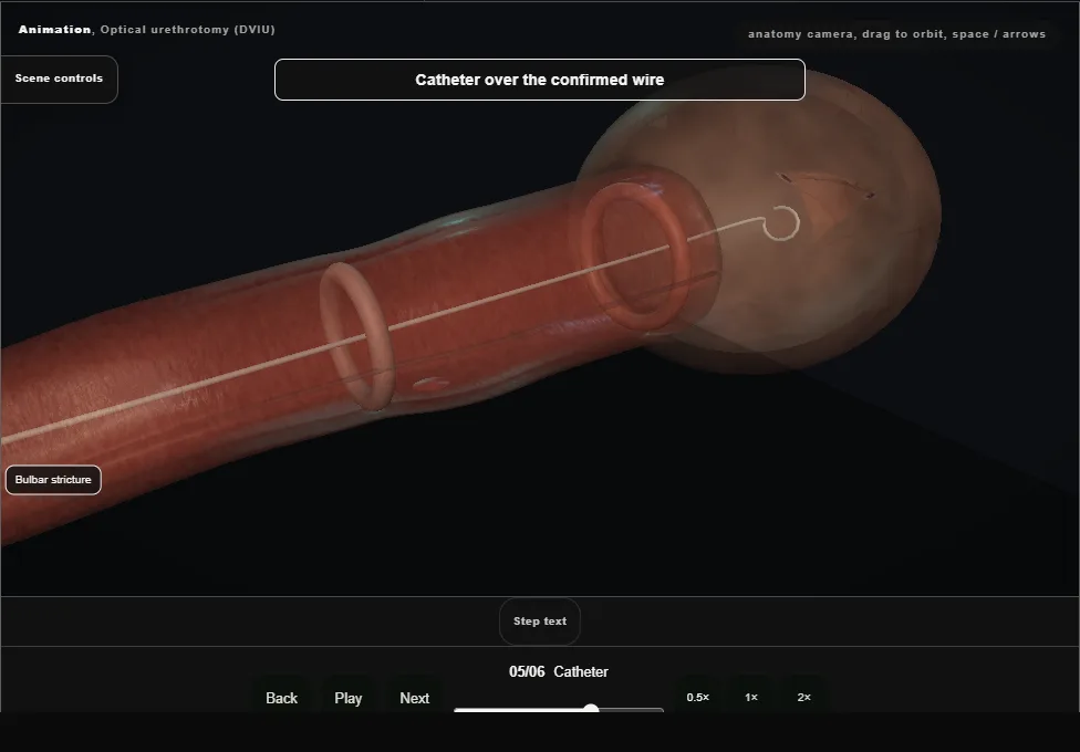 Optical urethrotomy (DVIU). Step 5: Catheter. Captured frame from the interactive animation.