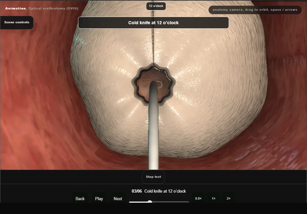 Optical urethrotomy (DVIU). Step 3: Cold knife at 12 o’clock. Captured frame from the interactive animation.