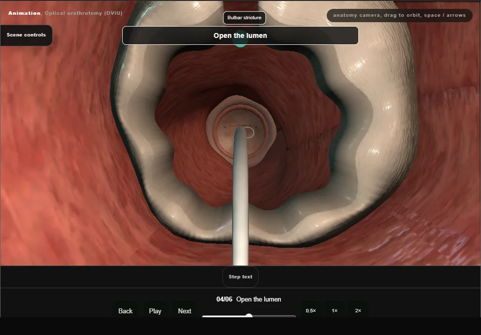 Optical urethrotomy (DVIU). Step 4: Open the lumen. Captured frame from the interactive animation.